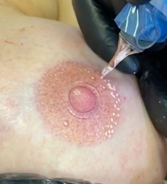 Areola Pigmentation Reconstruction Tattoo