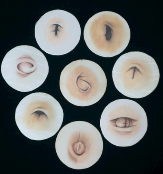 Bellybutton bellytuck surgery tattoo pigmentation