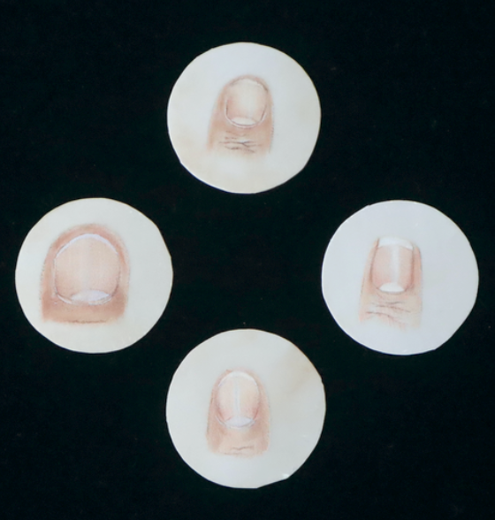 Nail Pigmentation Tattoo Replacemnt