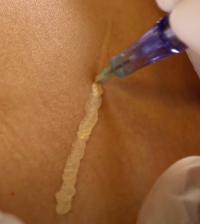 Scar Pigmentation Hide Scars